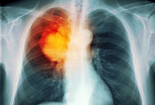Cancerul pulmonar vor provoca mai multe decese în rândul femeilor decât cel mamar